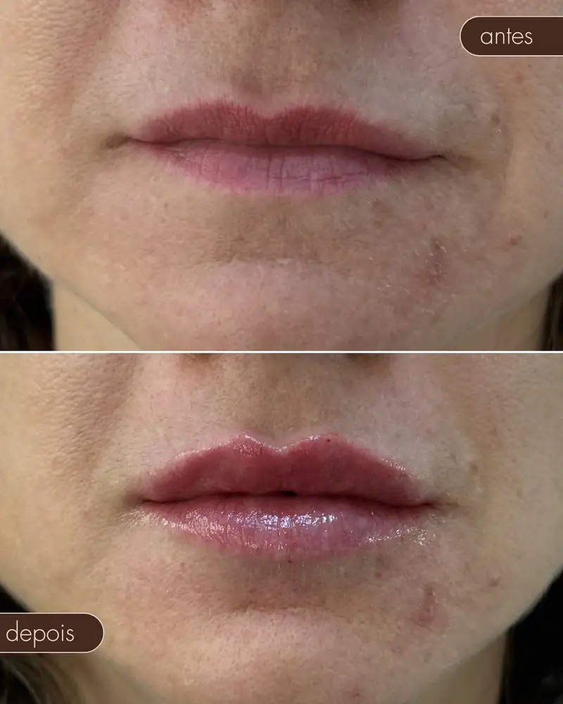 Antes e depois — Preenchimento de boca